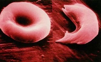 Sickle Cell Disease